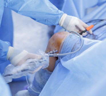 Close view of knee arthroscopy with PCL reconstruction showing arthroscope and cannulas on blue sterile drapes minimally invasive orthopedic surgery