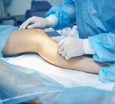 Close up of a leg of a patient with varicose vein and the doctor conducting laser treatment