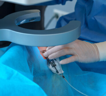 Close-up of a surgeon's gloved hand using a laser device during a precise eye surgery. Blue sterile drapes cover the area, ensuring a controlled surgical environment